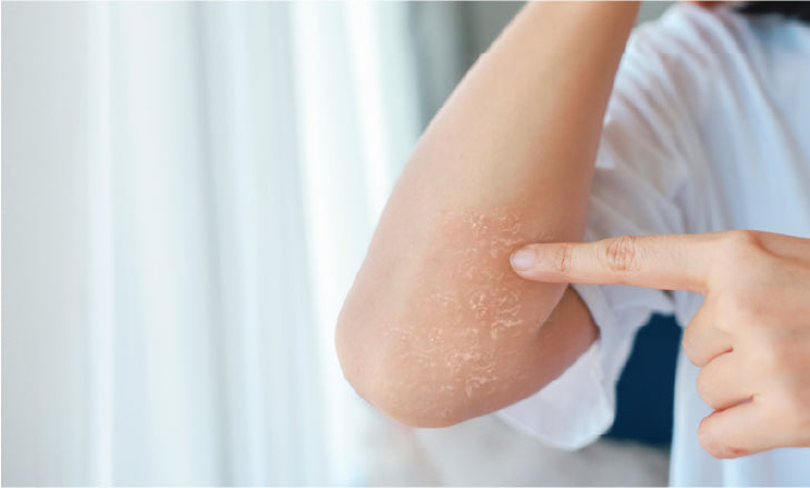 Managing Eczema and Dry Skin for Long-Term Relief