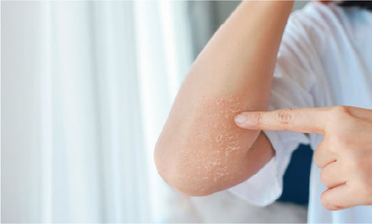 Managing Eczema and Dry Skin for Long-Term Relief